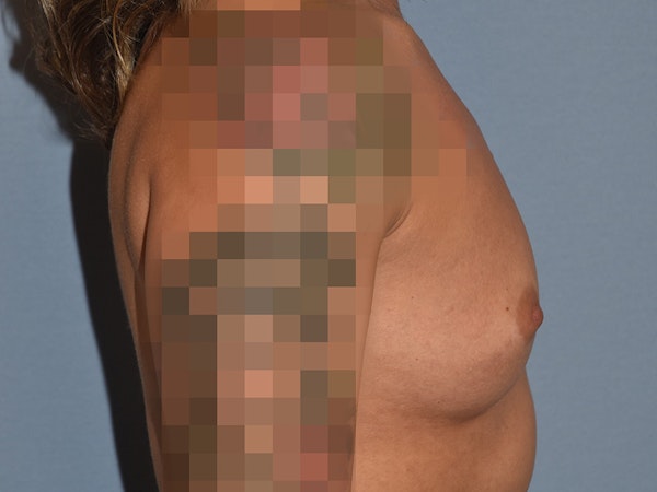 Breast Augmentation Before & After Gallery - Patient 226630 - Image 5