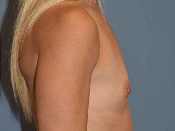 Breast Augmentation Before & After Gallery - Patient 296928 - Image 3