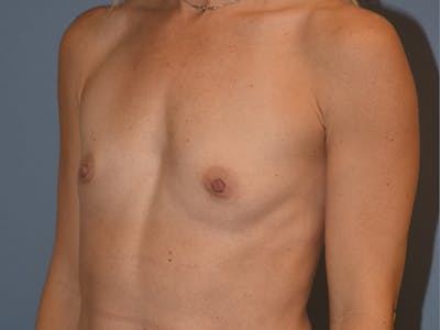 Breast Augmentation Before & After Gallery - Patient 296928 - Image 1