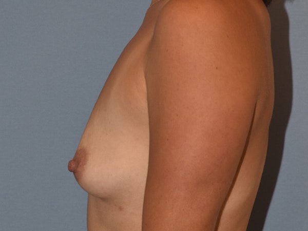 Breast Augmentation Before & After Gallery - Patient 202117 - Image 3