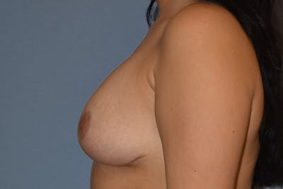 Breast Augmentation Lift Before & After Gallery - Patient 123662 - Image 10