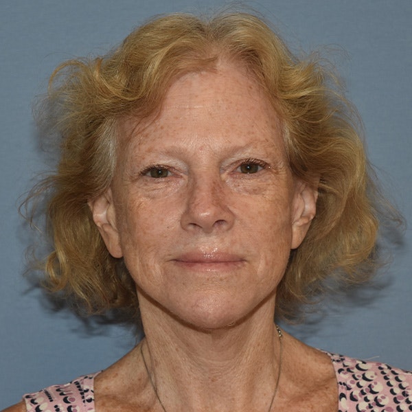 Facelift Before & After Gallery - Patient 299001 - Image 2