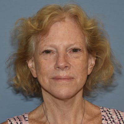 Facelift Before & After Gallery - Patient 299001 - Image 2