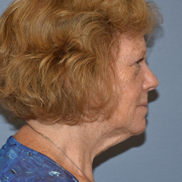 Facelift Before & After Gallery - Patient 299001 - Image 3