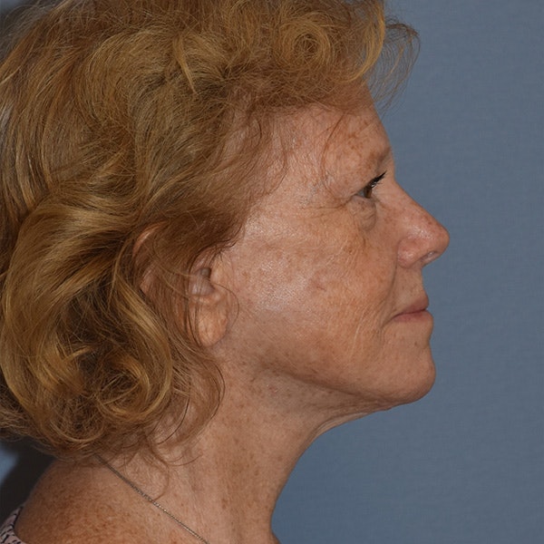 Facelift Before & After Gallery - Patient 299001 - Image 4