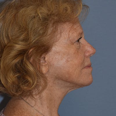 Facelift Before & After Gallery - Patient 299001 - Image 4