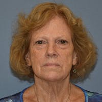 Facelift Before & After Gallery - Patient 299001 - Image 1