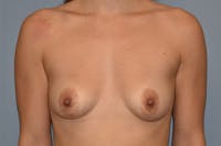 Breast Asymmetry Before & After Gallery - Patient 305148 - Image 1