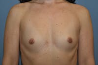 Breast Augmentation Before & After Gallery - Patient 265677 - Image 1