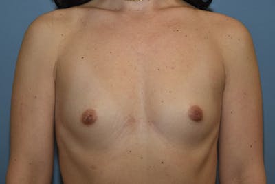 Breast Augmentation Before & After Gallery - Patient 265677 - Image 1