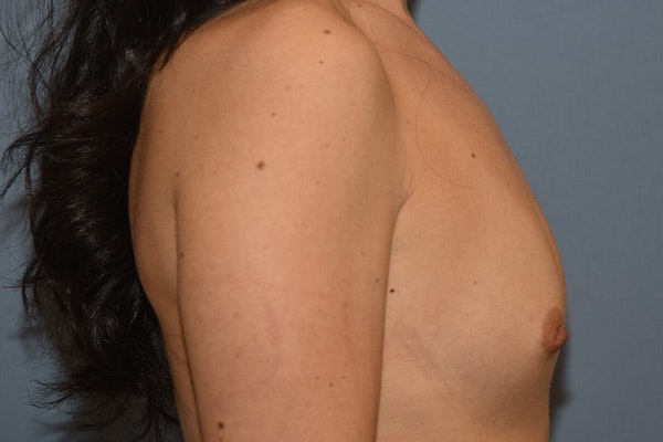 Breast Augmentation Before & After Gallery - Patient 265677 - Image 5