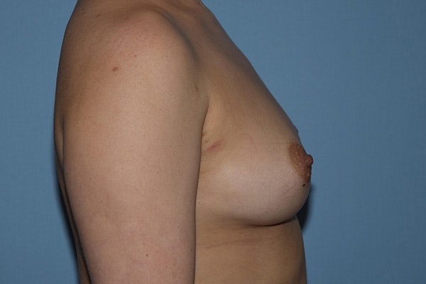 Breast Augmentation Before & After Gallery - Patient 387942 - Image 5