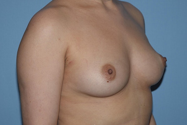 Breast Augmentation Before & After Gallery - Patient 387942 - Image 3