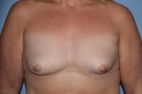 Breast Augmentation Before & After Gallery - Patient 314919 - Image 1