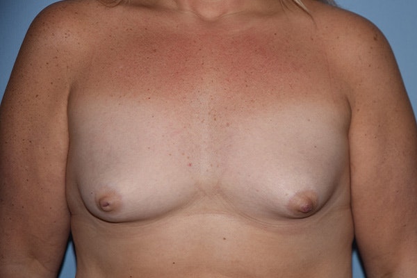 Breast Augmentation Before & After Gallery - Patient 314919 - Image 1