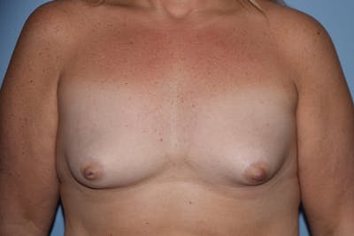 Breast Augmentation Before & After Gallery - Patient 314919 - Image 1