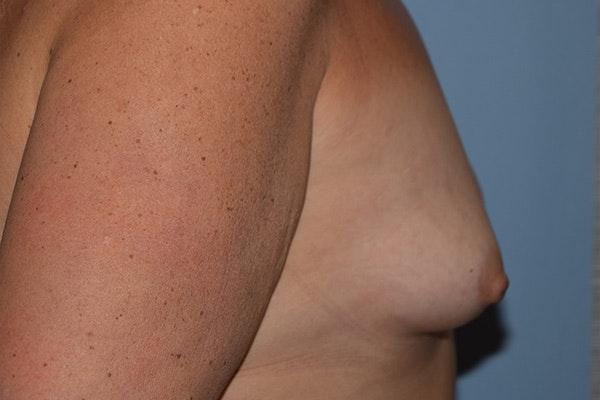 Breast Augmentation Before & After Gallery - Patient 314919 - Image 5
