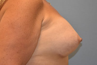 Breast Augmentation Before & After Gallery - Patient 314919 - Image 6