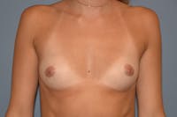 Breast Augmentation Before & After Gallery - Patient 306369 - Image 1