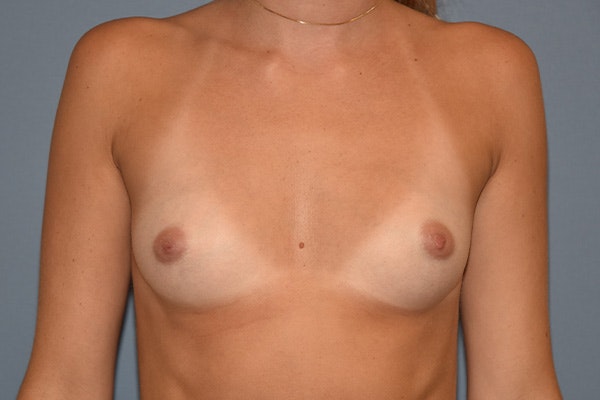 Breast Augmentation Before & After Gallery - Patient 306369 - Image 1