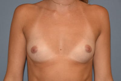 Breast Augmentation Before & After Gallery - Patient 306369 - Image 1