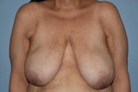 Breast Reduction Before & After Gallery - Patient 212034 - Image 1