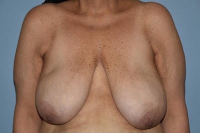 Breast Reduction Before & After Gallery - Patient 212034 - Image 1