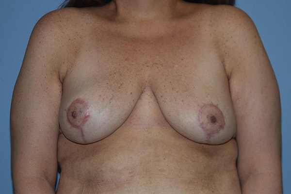 Breast Reduction Before & After Gallery - Patient 212034 - Image 2