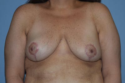 Breast Reduction Before & After Gallery - Patient 212034 - Image 2