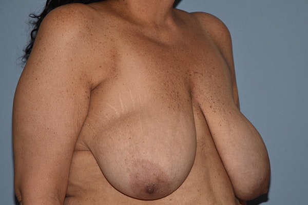 Breast Reduction Before & After Gallery - Patient 212034 - Image 3