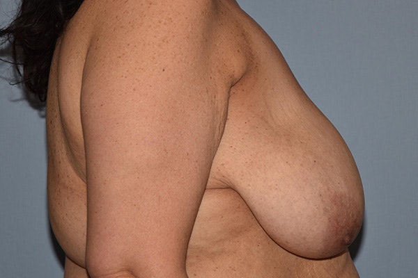 Breast Reduction Before & After Gallery - Patient 212034 - Image 5