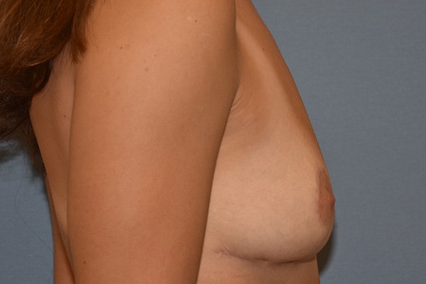Breast Reduction Before & After Gallery - Patient 172841 - Image 6