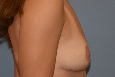 Breast Reduction Before & After Gallery - Patient 172841 - Image 6