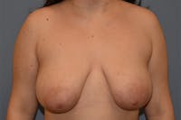 Breast Reduction Before & After Gallery - Patient 428741 - Image 1