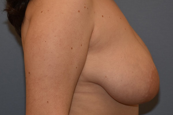 Breast Reduction Before & After Gallery - Patient 428741 - Image 5