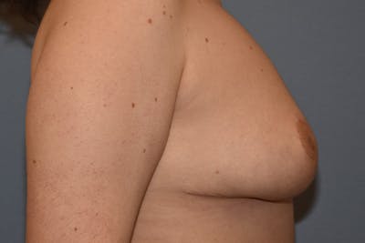 Breast Reduction Before & After Gallery - Patient 428741 - Image 6