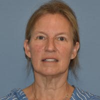 Facelift Before & After Gallery - Patient 201320 - Image 1