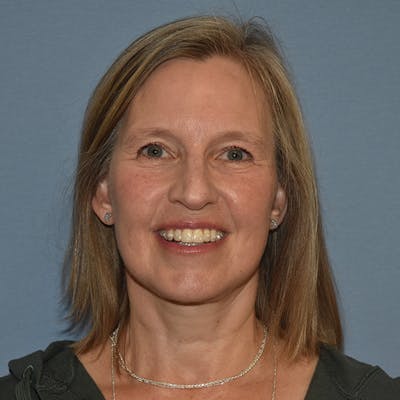 Facelift Before & After Gallery - Patient 201320 - Image 2