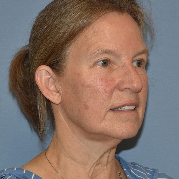 Facelift Before & After Gallery - Patient 201320 - Image 3