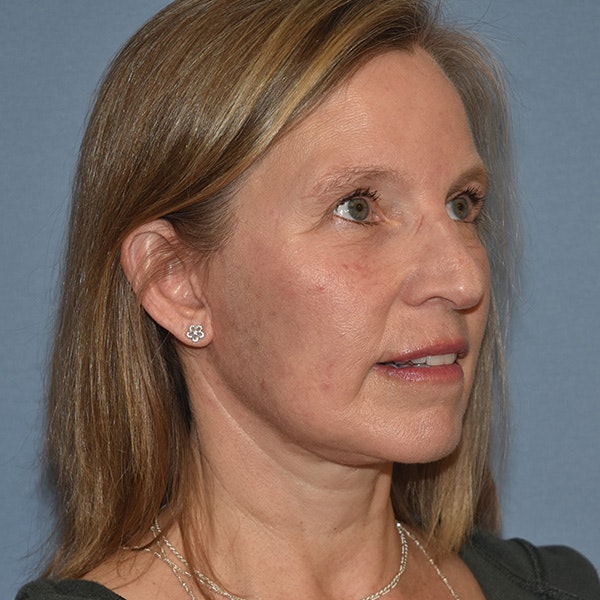 Facelift Before & After Gallery - Patient 201320 - Image 4