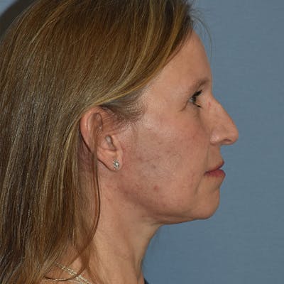 Facelift Before & After Gallery - Patient 201320 - Image 6