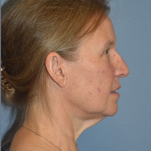 Facelift Before & After Gallery - Patient 201320 - Image 5