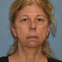 Facelift Before & After Gallery - Patient 875789 - Image 1