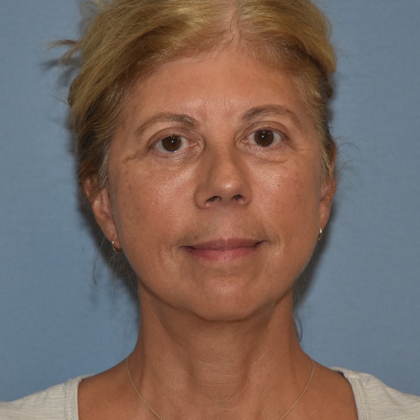 Facelift Before & After Gallery - Patient 875789 - Image 2