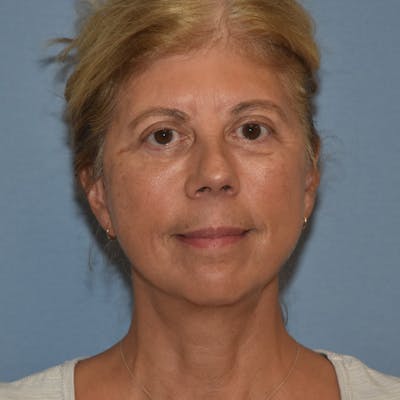 Facelift Before & After Gallery - Patient 875789 - Image 2