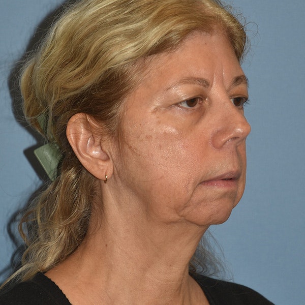 Facelift Before & After Gallery - Patient 875789 - Image 3