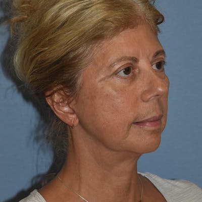 Facelift Before & After Gallery - Patient 875789 - Image 4