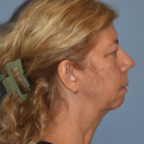 Facelift Before & After Gallery - Patient 875789 - Image 5