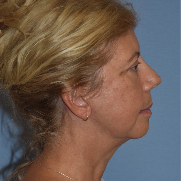 Facelift Before & After Gallery - Patient 875789 - Image 6