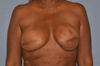 Breast Reconstruction Before & After Gallery - Patient 387876 - Image 1